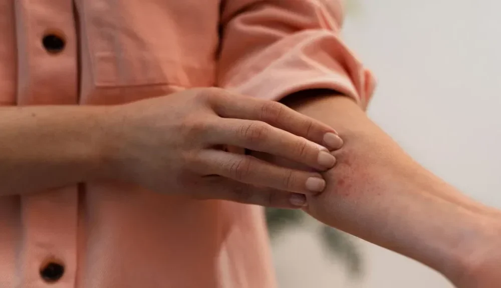 Sexually transmitted ringworm found in man who had affair with multiple men